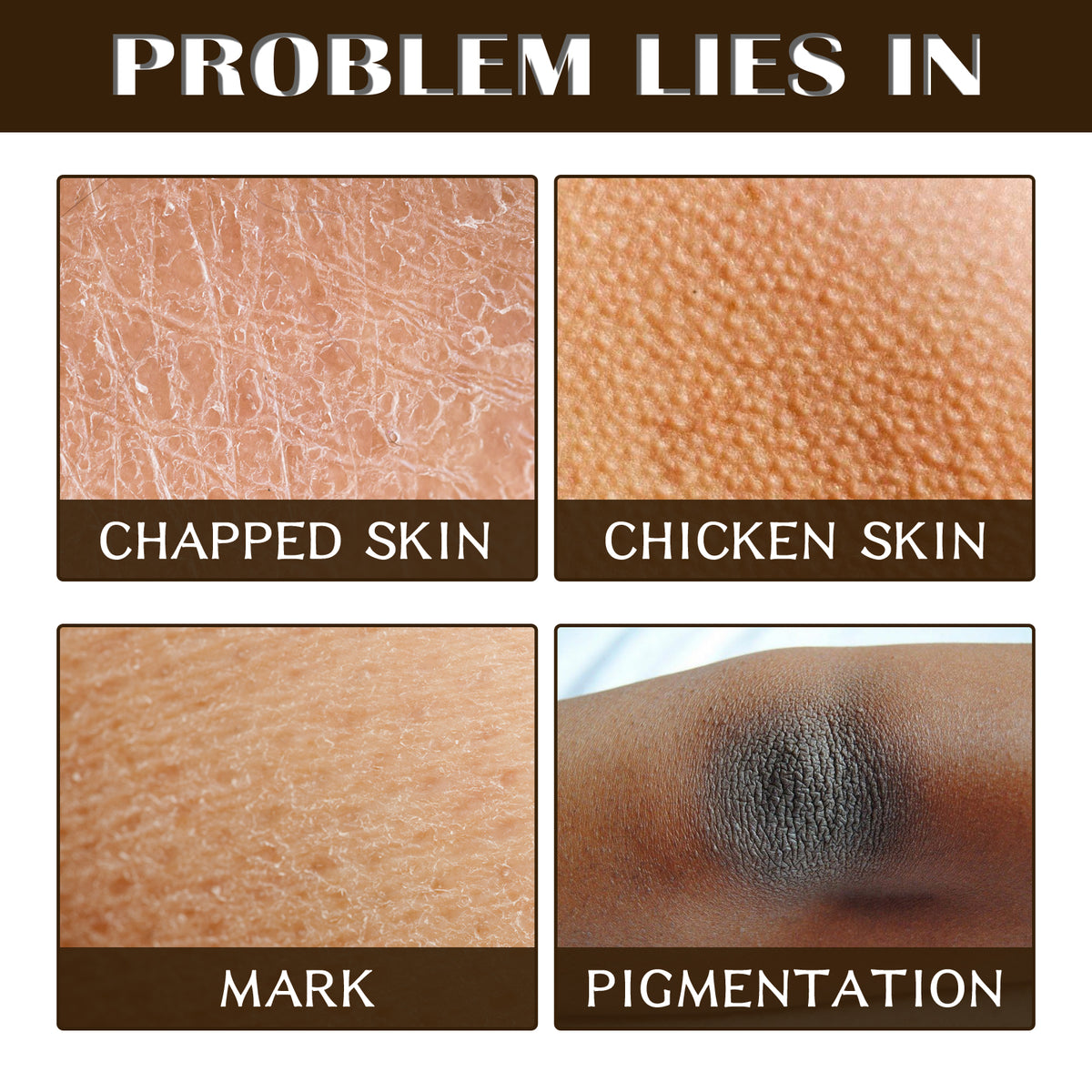 Four panels showing skin issues: chapped, chicken skin, mark, and pigmentation.